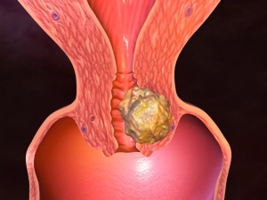 obat tumor rahim
